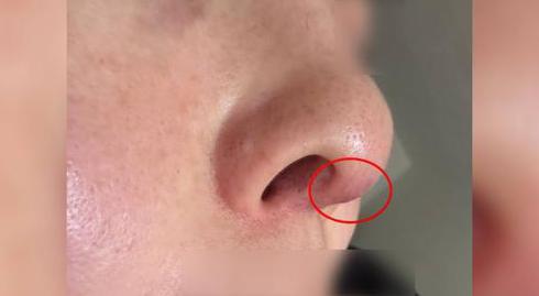 盈透科技 隆鼻一年多假体凸出、鼻小柱变宽 市民想退费遭拒